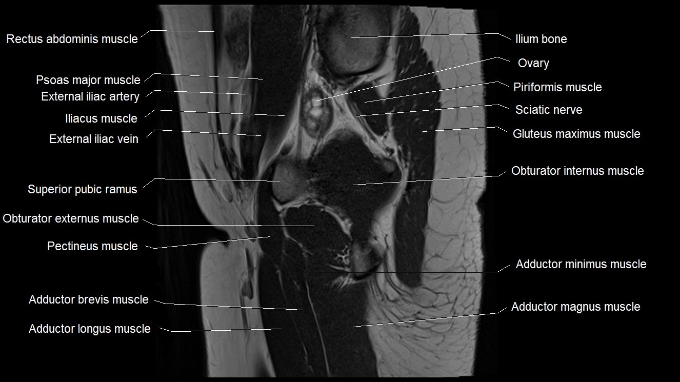Hip sagittal cross sectional anatomy image 26.webp